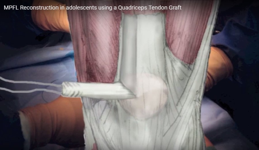 Mpfl Reconstruction In Adolescents Using A Quadriceps Tendon Graft —