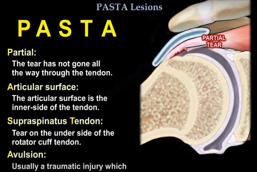 pasta-of-the-shoulder-orthopaedicprinciples