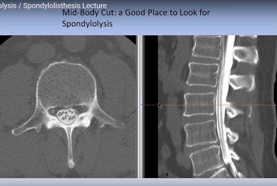 spondylolisthesis radiology