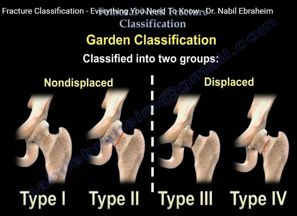 Garden Classification Femoral Neck Fracture