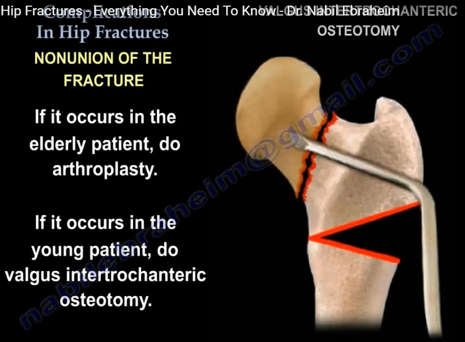 case study fractured hip with postoperative complications