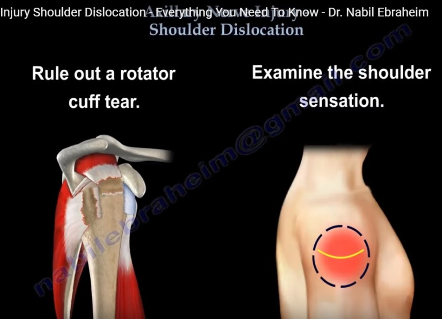Axillary Nerve Injury in Shoulder Dislocation — OrthopaedicPrinciples.com