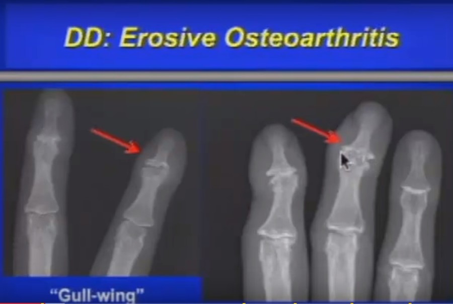 Imaging of Arthritis — OrthopaedicPrinciples.com