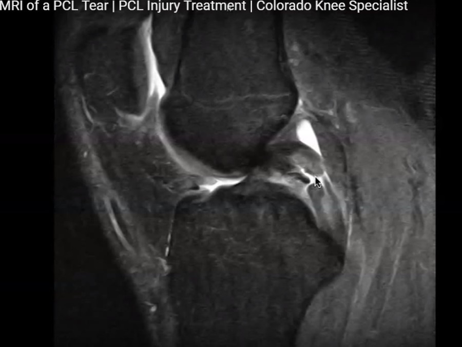 MRI in PCL Tear — OrthopaedicPrinciples.com