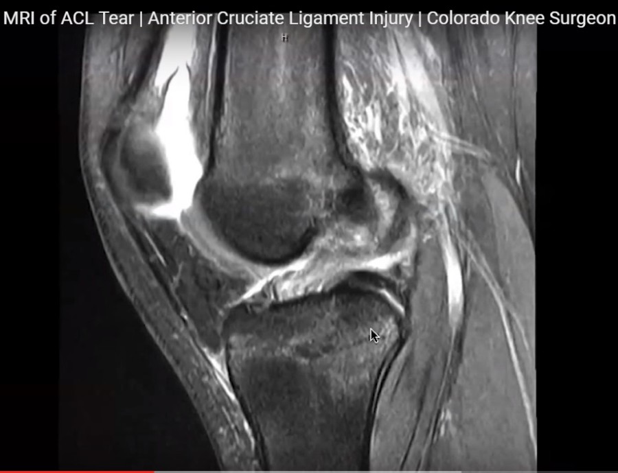 MRI In Anterior Cruciate Ligament Tear — OrthopaedicPrinciples.com