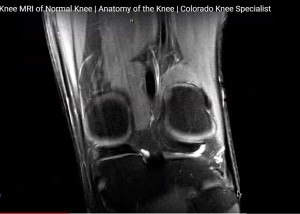 Mri Of A Normal Knee — Orthopaedicprinciples.com