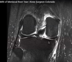 MRI in Meniscal Root Tears — OrthopaedicPrinciples.com