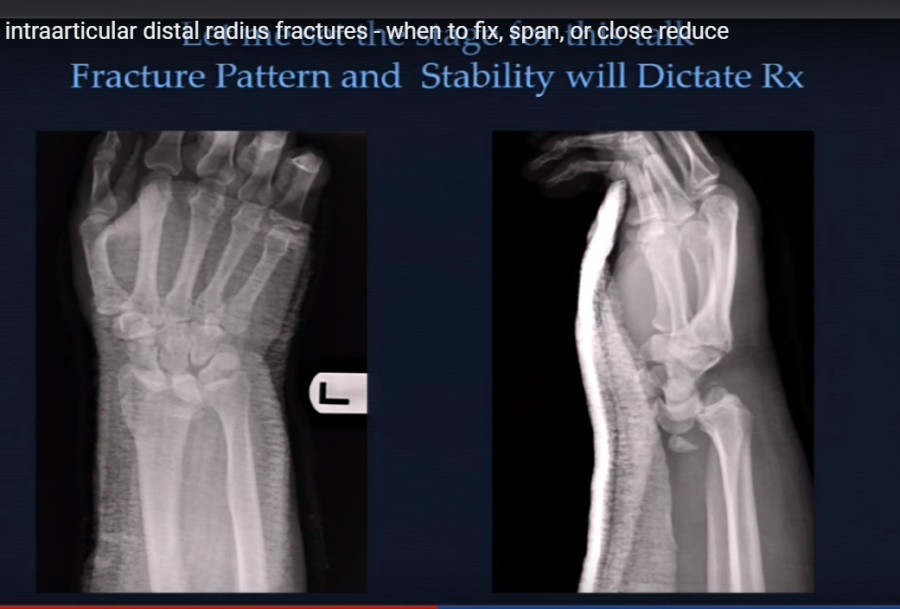 When To Fix Span Or Closed Reduce In Comminuted Distal Radius Fractures —