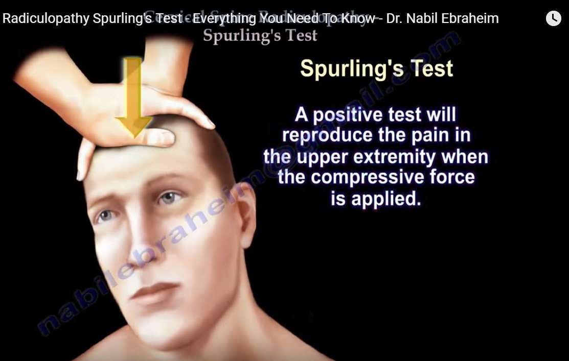 cervical-spine-radiculopathy-and-spurling-test-orthopaedicprinciples