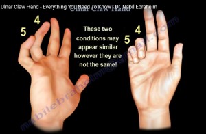 Intrinsic Minus and Intrinsic Plus Hand — OrthopaedicPrinciples.com