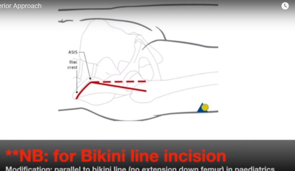 Anterior Approach To The Hip — 