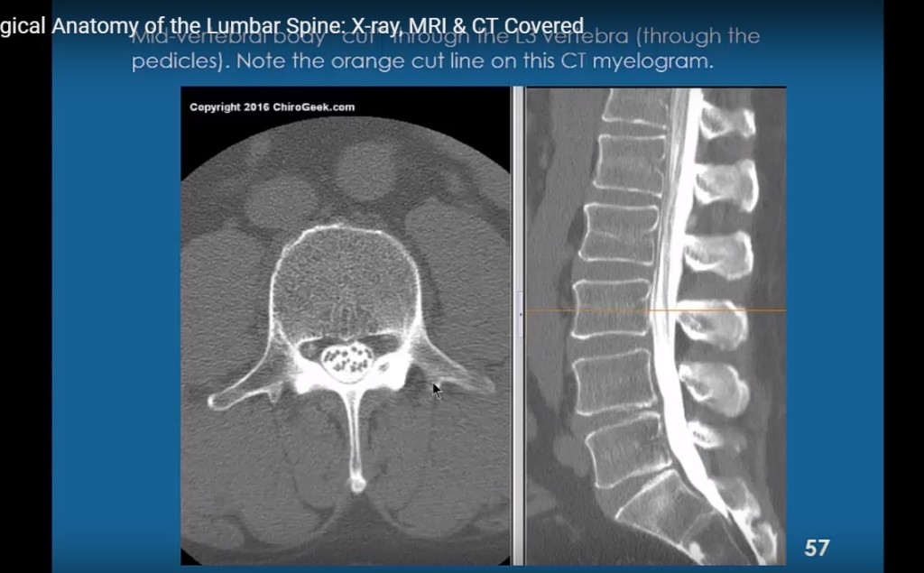 Radiological anatomy of Spine with Imaging correlation ...