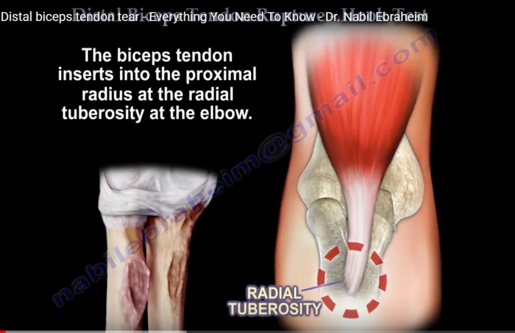 Biceps Tendon Tear Test 3467