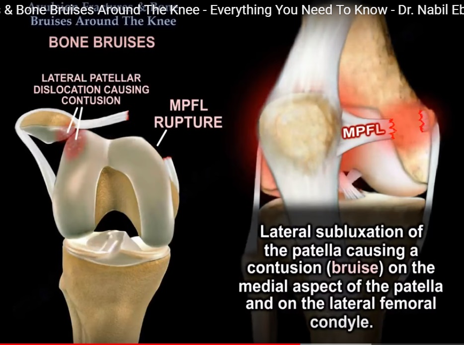 Avulsion injuries around the Knee 