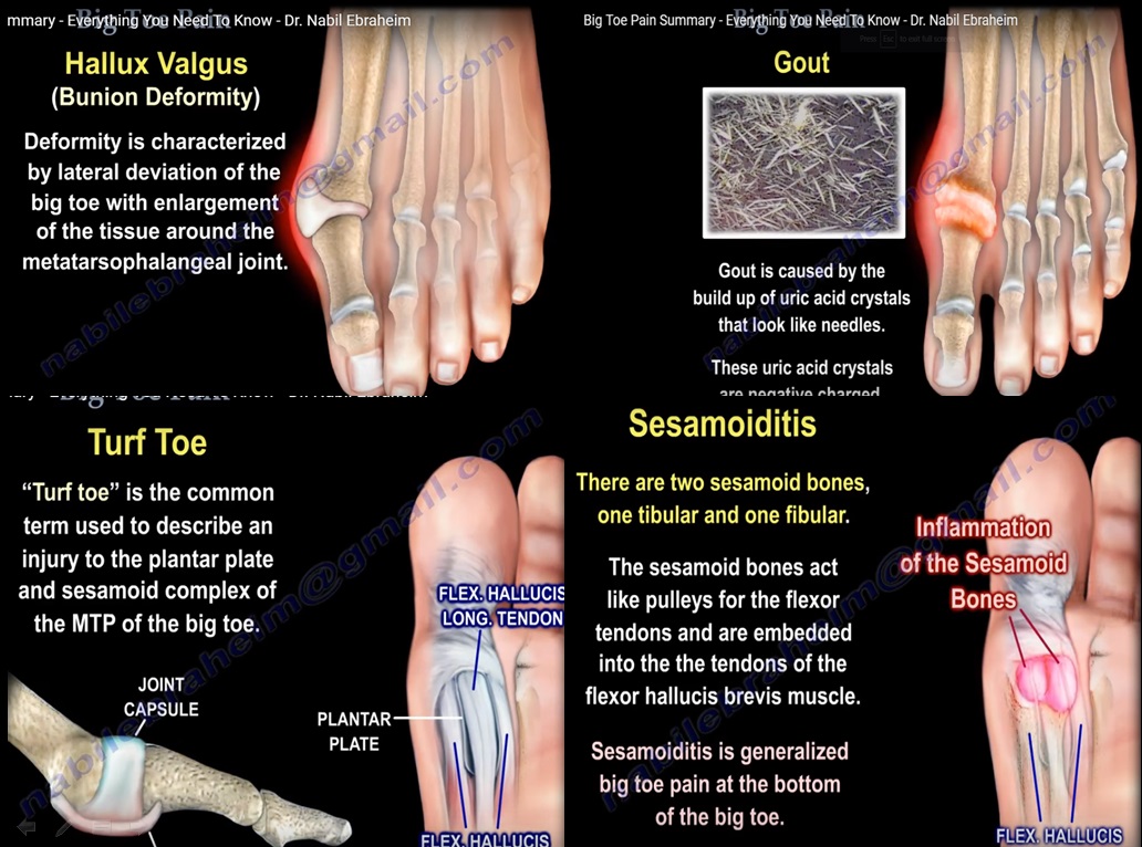 Differential Diagnosis of Big Toe Pain — OrthopaedicPrinciples.com