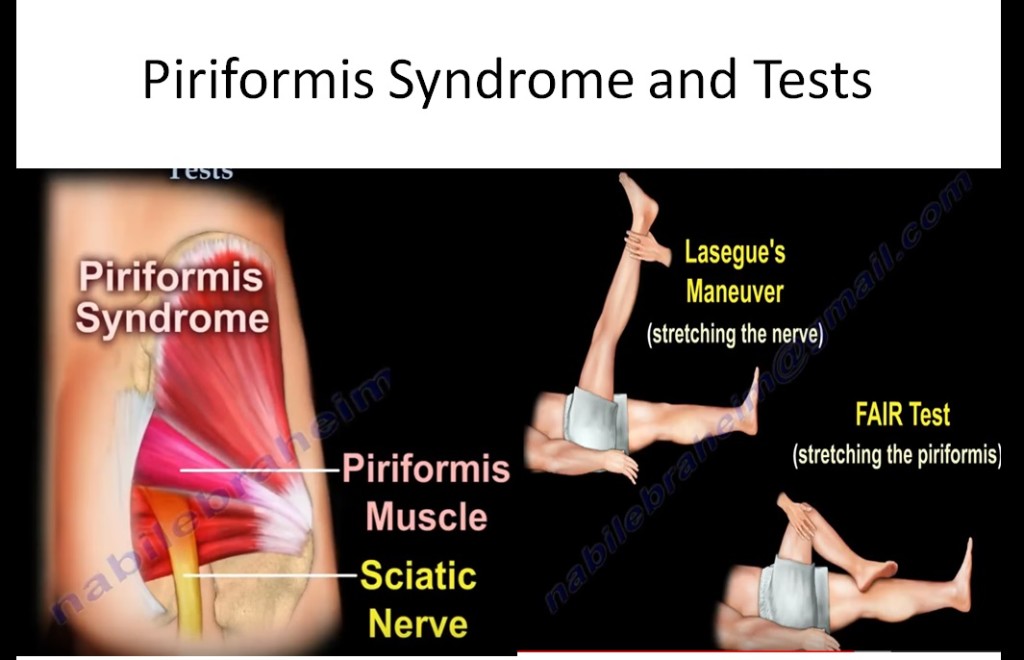 Piriformis Syndrome And Tests —
