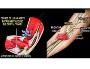 Cubital Tunnel Syndrome — OrthopaedicPrinciples.com