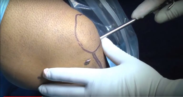 ACL Reconstruction using Hamstring graft — OrthopaedicPrinciples.com