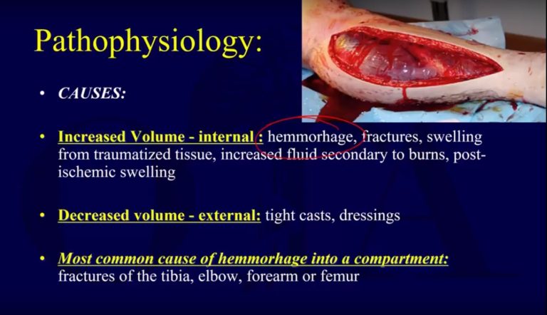 Pathophysiology Of Compartment Syndrome Orthopaedicprinciples Com