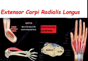 Extensor Carpi Radialis Longus — OrthopaedicPrinciples.com