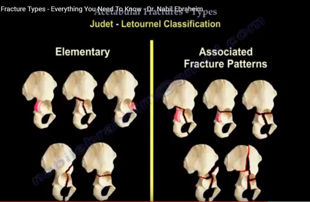 Acetabulum Fracture Classification —