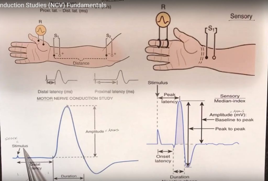 Fundamentals of Nerve Conduction Study — OrthopaedicPrinciples.com