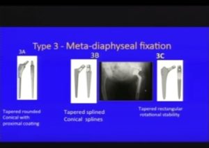 Femoral Stem Options In Total Hip Replacement — OrthopaedicPrinciples.com