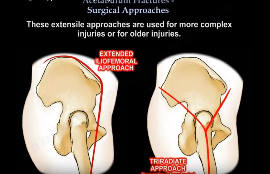 Surgical approaches to the Acetabulum — OrthopaedicPrinciples.com