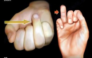 The Jersey Finger — OrthopaedicPrinciples.com