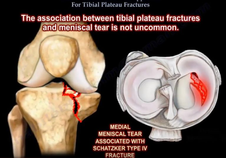 Extensile Approach For Tibial Plateau Fractures — 8253