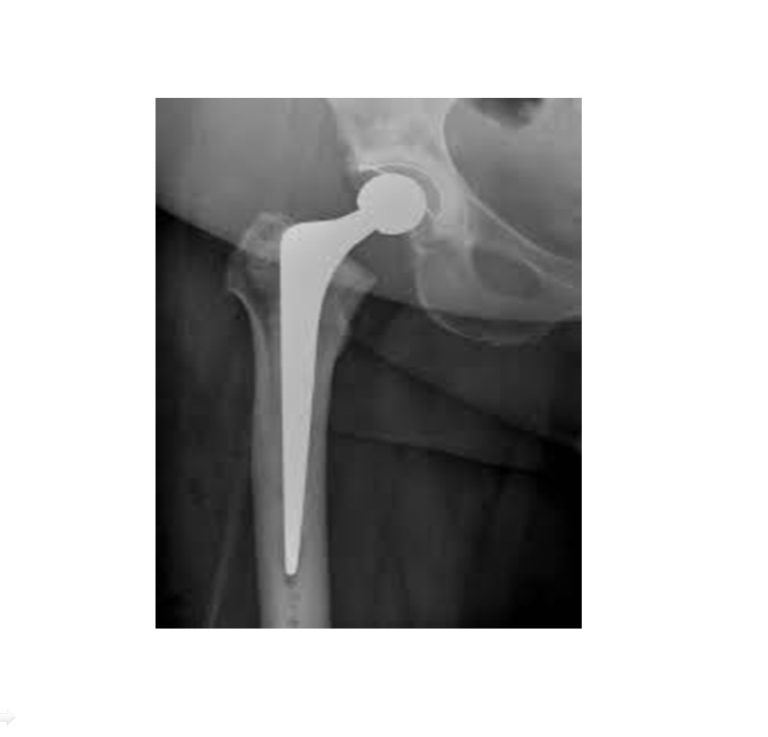 Cemented Total Hip Replacement — OrthopaedicPrinciples.com