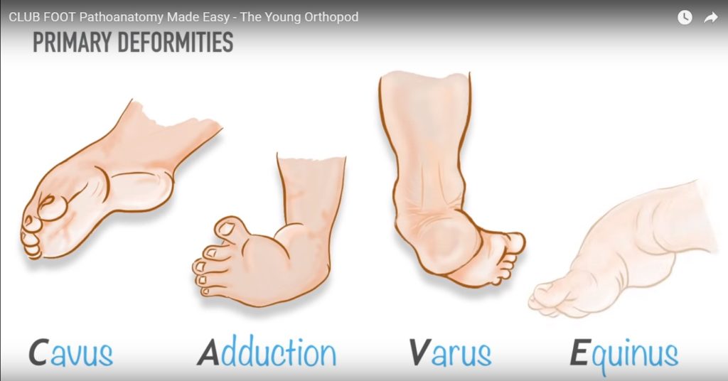 Congenital Talipes Equinovarus —