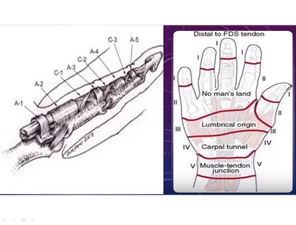 Flexor Tendon Injuries of the Hand — OrthopaedicPrinciples.com