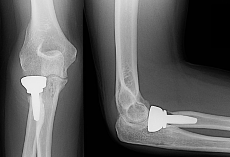 Radial Head Replacement — OrthopaedicPrinciples.com