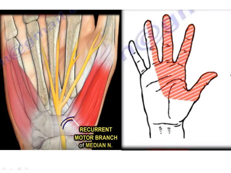 Ganglion Cyst in the Carpal Tunnel — OrthopaedicPrinciples.com