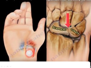 Ganglion Cysts of the Wrist — OrthopaedicPrinciples.com