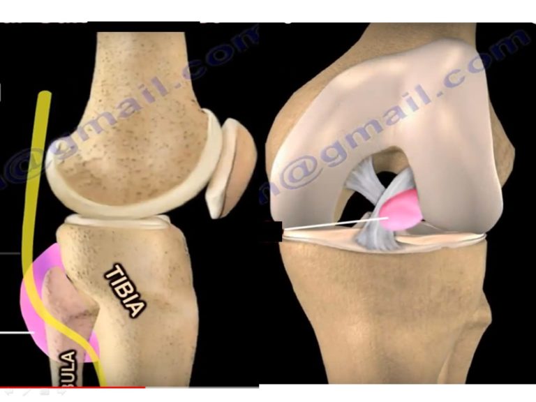 Ganglion Cysts around the Knee Joint — OrthopaedicPrinciples.com