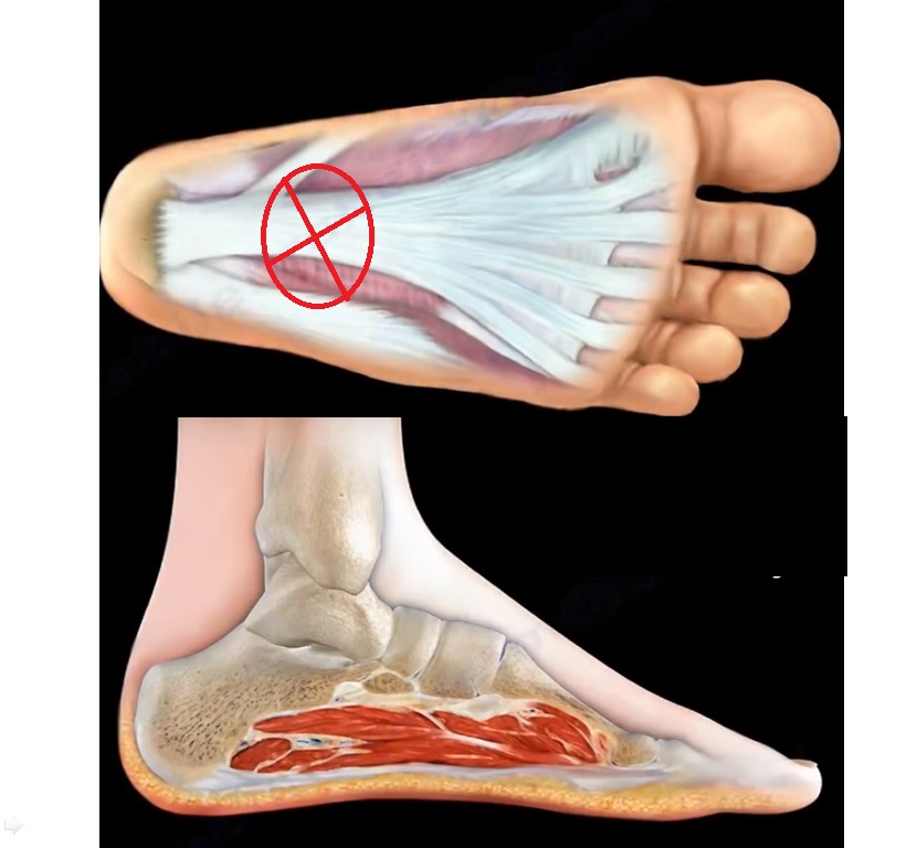 Plantar fasciitis pics information