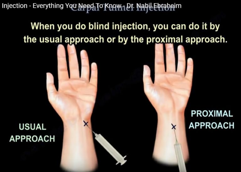 carpal-tunnel-syndrome-cts-cause-pathophysiology-and-treatments