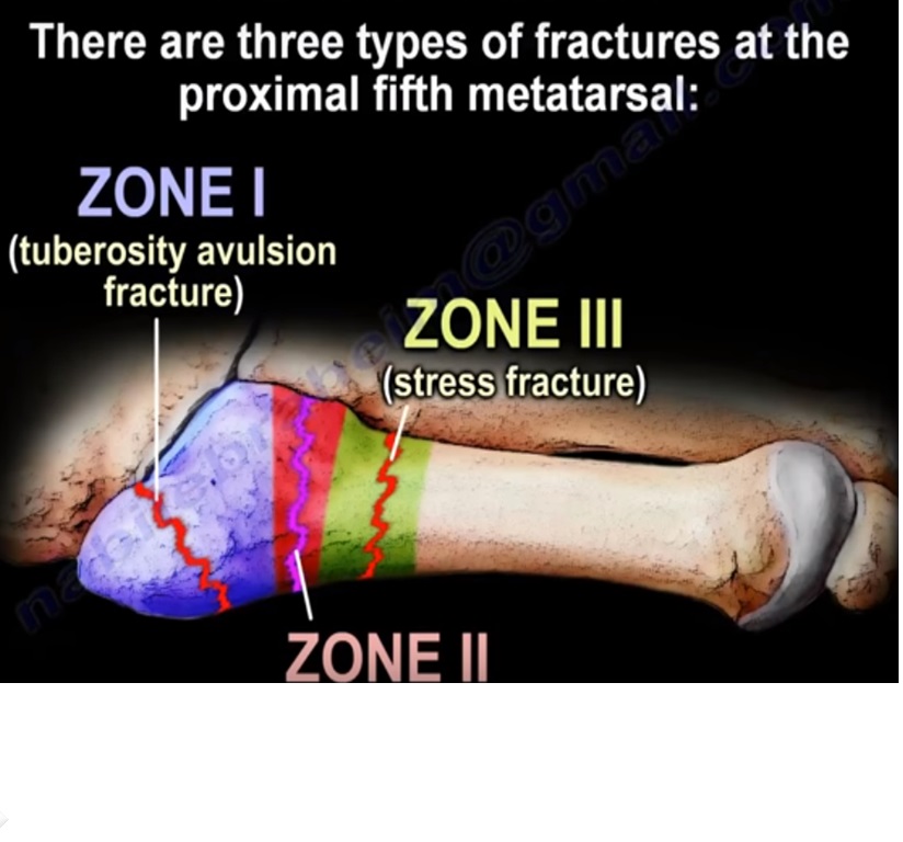 Jones fracture of the 5th Metatarsal — OrthopaedicPrinciples.com