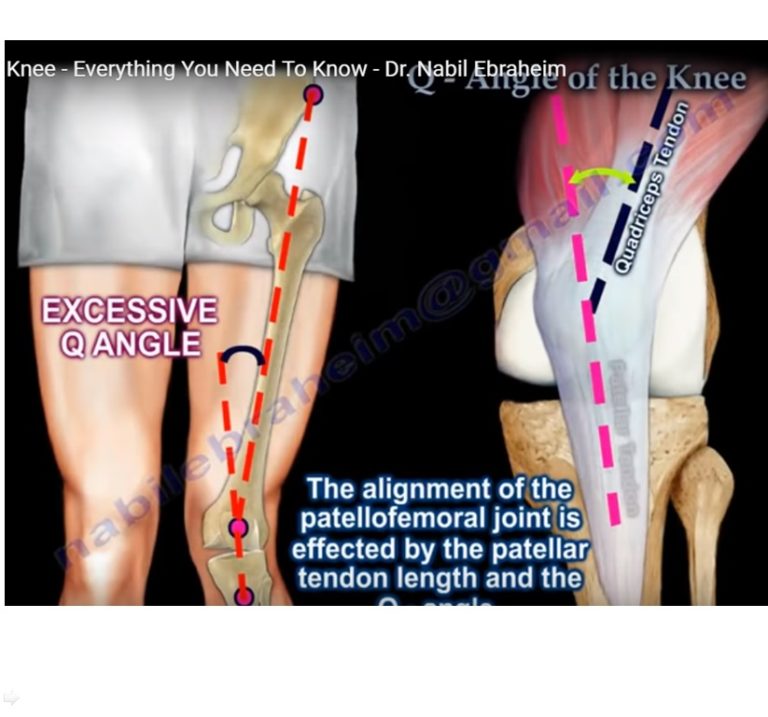 Q angle of the Knee Joint — OrthopaedicPrinciples.com