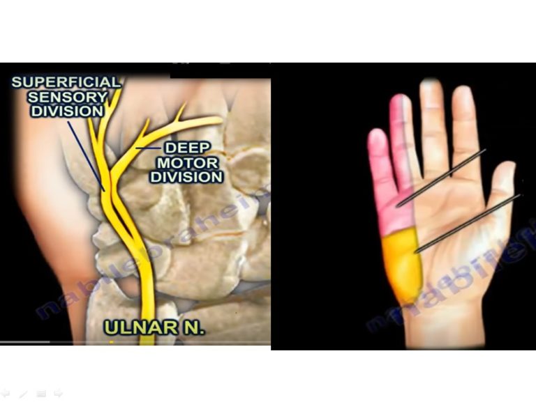 Guyon’s Canal Syndrome — OrthopaedicPrinciples.com