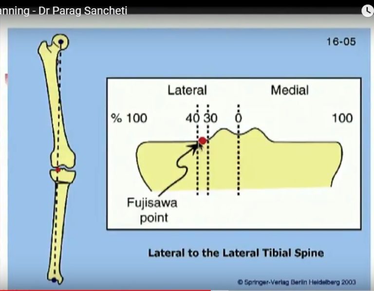 High Tibial Osteotomy- Planning And Indications — OrthopaedicPrinciples.com