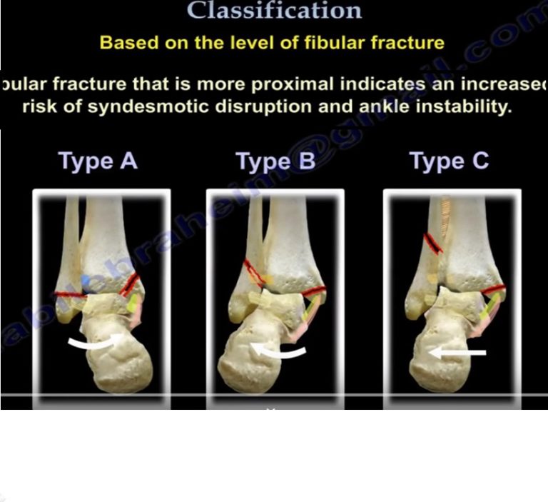 Danis Weber Classification Of Ankle Fractures — OrthopaedicPrinciples.com