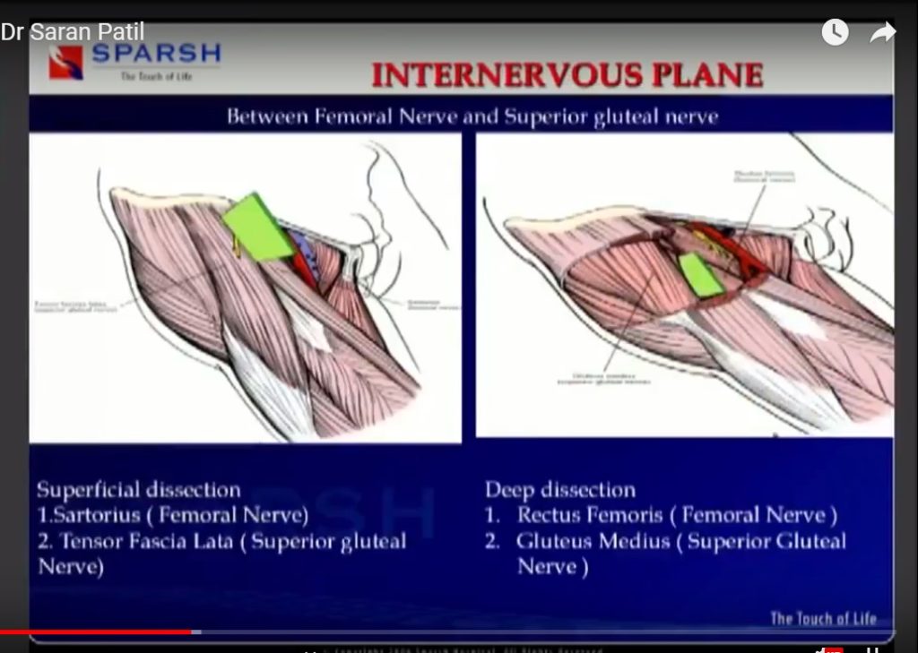 Direct Anterior Approach For Total Hip Replacement — 9679