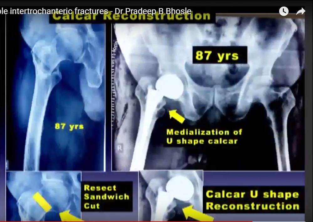 intertrochanteric fracture