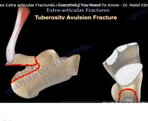 ExtraArticular Calcaneal Fractures — OrthopaedicPrinciples.com