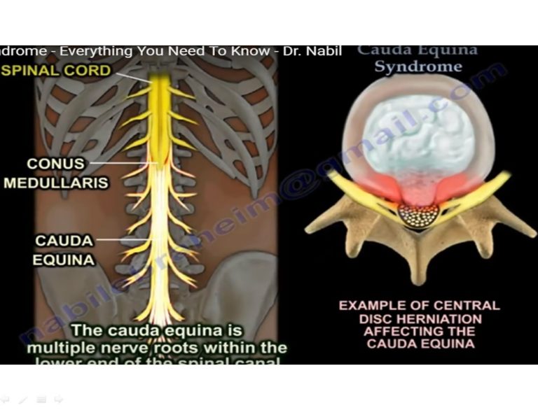 Cauda Equina Syndrome — 5583