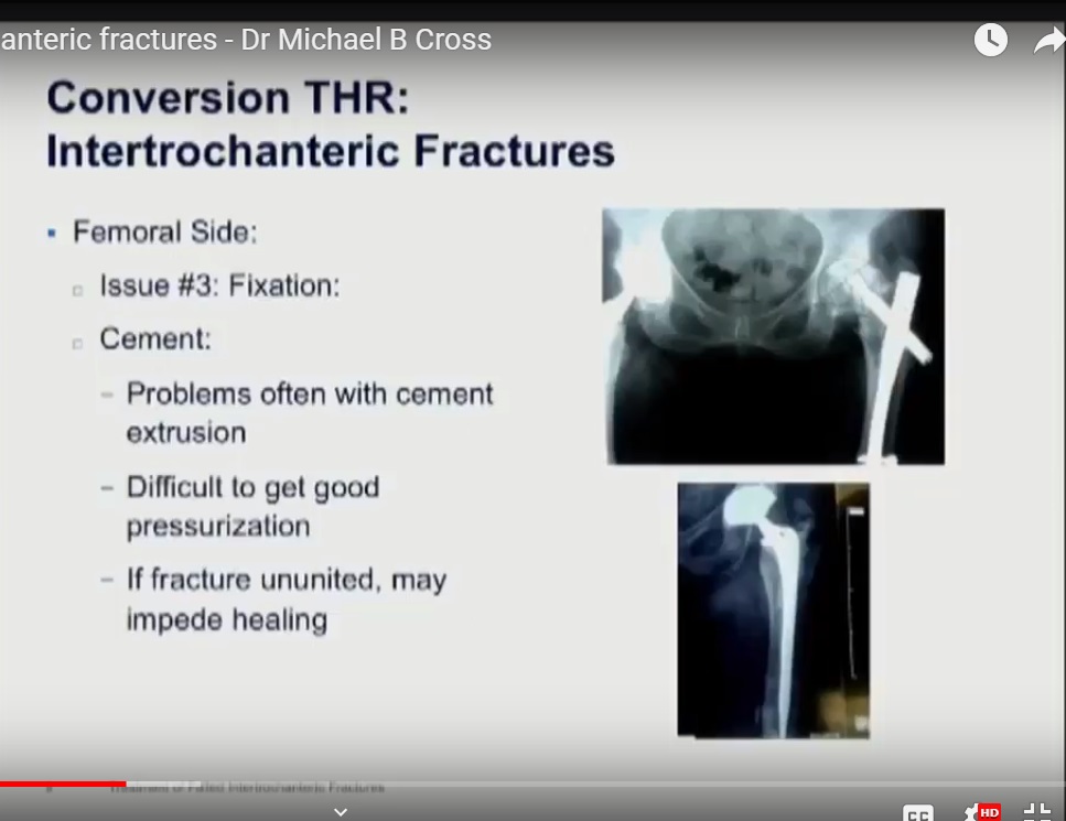 icd 10 code for intertrochanteric fracture of right femur