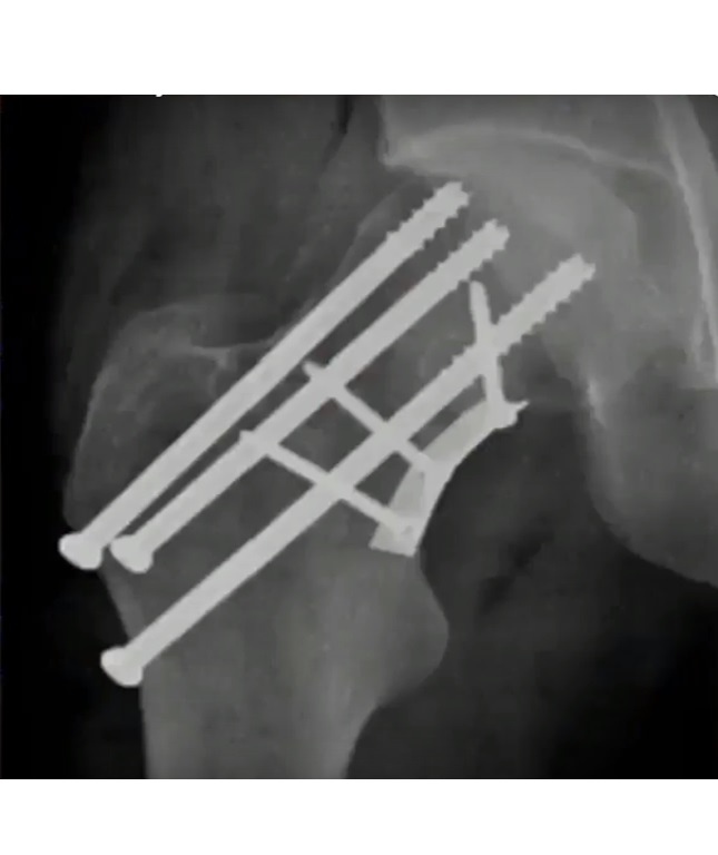 femoral neck pathological fracture icd 10